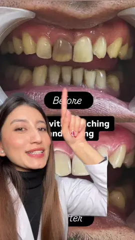 Management of non vital tooth #bleaching #teethwhitening #hamromultispecialitydentalclinic #draastha #dentistinnepal