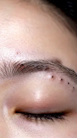 The most satisfying blackhead vacuum extraction ever!! Real deep pore cleaning ASMR for stress relief 🧘‍♀️ #asmr #skincare #relaxing #satisfying #facial 