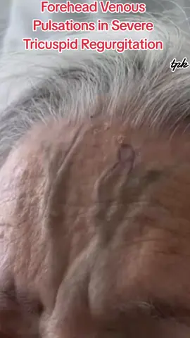 Severe tricuspid regurgitation (TR) is a heart condition where the tricuspid valve doesn't close properly, causing blood to leak backward into the right atrium. This can lead to symptoms of right-sided heart failure, such as fatigue, shortness of breath, swelling in the legs, abdomen, or neck, and a fluttering or pounding in the neck. Without treatment, severe TR can worsen, leading to heart failure and other serious conditions. 