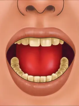 Heavy Tartar Removal ASMR | Deep Dental Cleaning #tartarremoval #asmr #teethcleaning #teethasmr #teethwhitening 