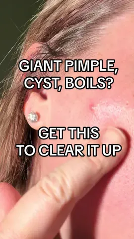 Giant pimples? Cysts? Boils? HS? They this, it works so good. #pimples #pimple #cyst #boil #acne 