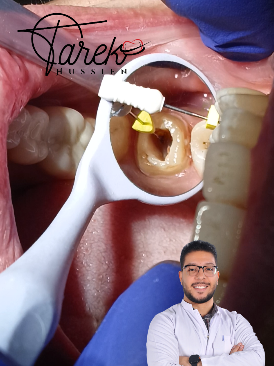Endodontic retreatment  MB2 #dentist #Tarek_Hussien #endodontics #explore #isolation 