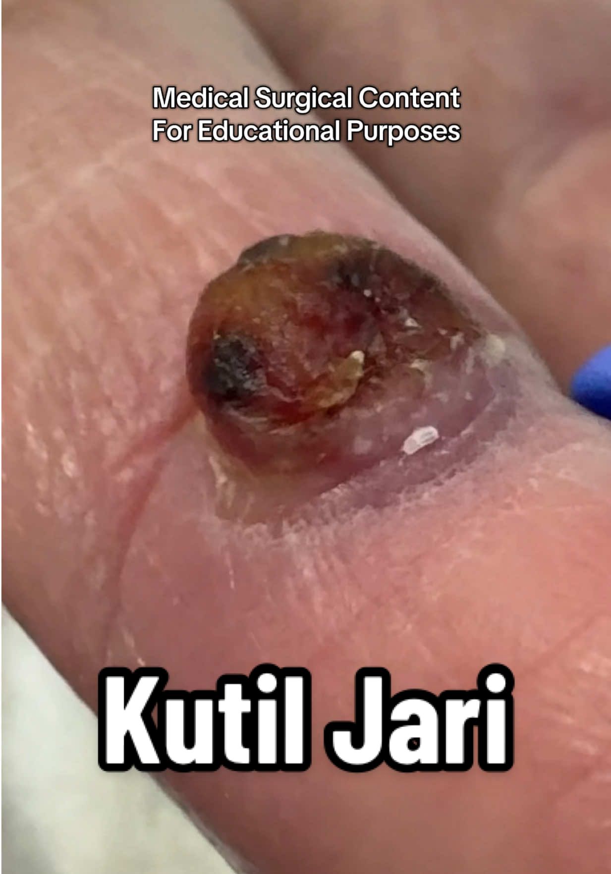 Kutil Tumbuh Kat Jari #DrManTtdi #KlinikTtdi #LaserKutil #Kutil #SkinTag 