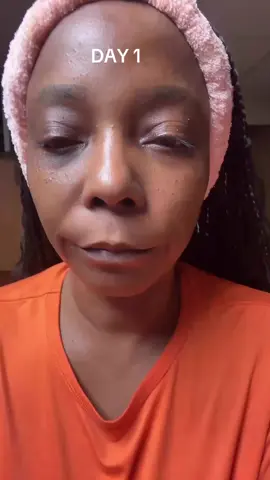 Seoul 1988 Advanced Shot Retinal Liposome 12% + Black Rice  This powerful retinal treatment combines 12% stabilized retinal liposomes with nutrient-rich black rice to target texture, fine lines, and overall skin clarity. The formula works to support cell turnover while keeping the skin balanced and nourished, helping reveal a smoother and more refined complexion over time. With consistent use, this treatment helps brighten dullness, improve elasticity, and create a firmer, more even-looking appearance. A great option for those wanting an effective, high-strength renewal step in their nighttime routine @seoul1988oficial  #Seoul1988 #RetinalShot  #foryoupage #SkinRenewal #AntiAgingSkincare 