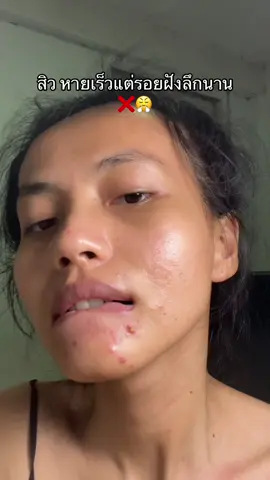 #เจลแต้มสิวเมดิต้า  #เจลละลายสิว  #เมดิต้า  #meditaเจลแต้มสิว  #สิวยุบไวไร้ร่องรอย 