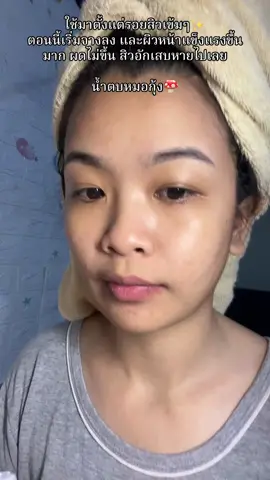 ผิวดีขึ้น ฉ่ำชุ่มชื่นผิวแข็งแรงขึ้นแบบรู้สึกได้เลย#น้ําตบเห็ดพิโค่ #น้ำตบ #น้ำตบหมอกุ้ง 