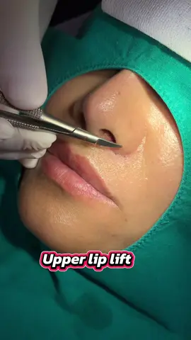 ครบกำหนด ตัดไหม ❤️ คุณหมอเปิ้ล นายแพทย์พลศักดิ์ วรไกร เลขที่ใบอนุญาตประกอบวิชาชีพเวชกรรม ว.33206 แพทย์ทั่วไป ปริญญาตรีแพทยศาสตร์บัณฑิต   ***ใช้เป็นตัวอย่าง ผลจากการเข้ารับการรักษาพยาบาล สำหรับผู้ป่วยเฉพาะราย*** #เ#เก็บบันทึกภาพเป็นปัจจุบัน#drappleclinicห#หมอเปิ้ลป#ปากกระจับต#ตัดปีกจมูก #liplift