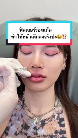 ฟิลเลอร์ร่องแก้มทำให้หน้าเด็กลงจริงป่ะ😩⁉️ #Auraxpress #ฟิลเลอร์ร่องแก้ม #filler #คลินิกฉีดหน้า #ฉีดหน้า 
