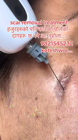 #scar #removal#pigmentation #facial #fyppppppppppppppppppppppp 