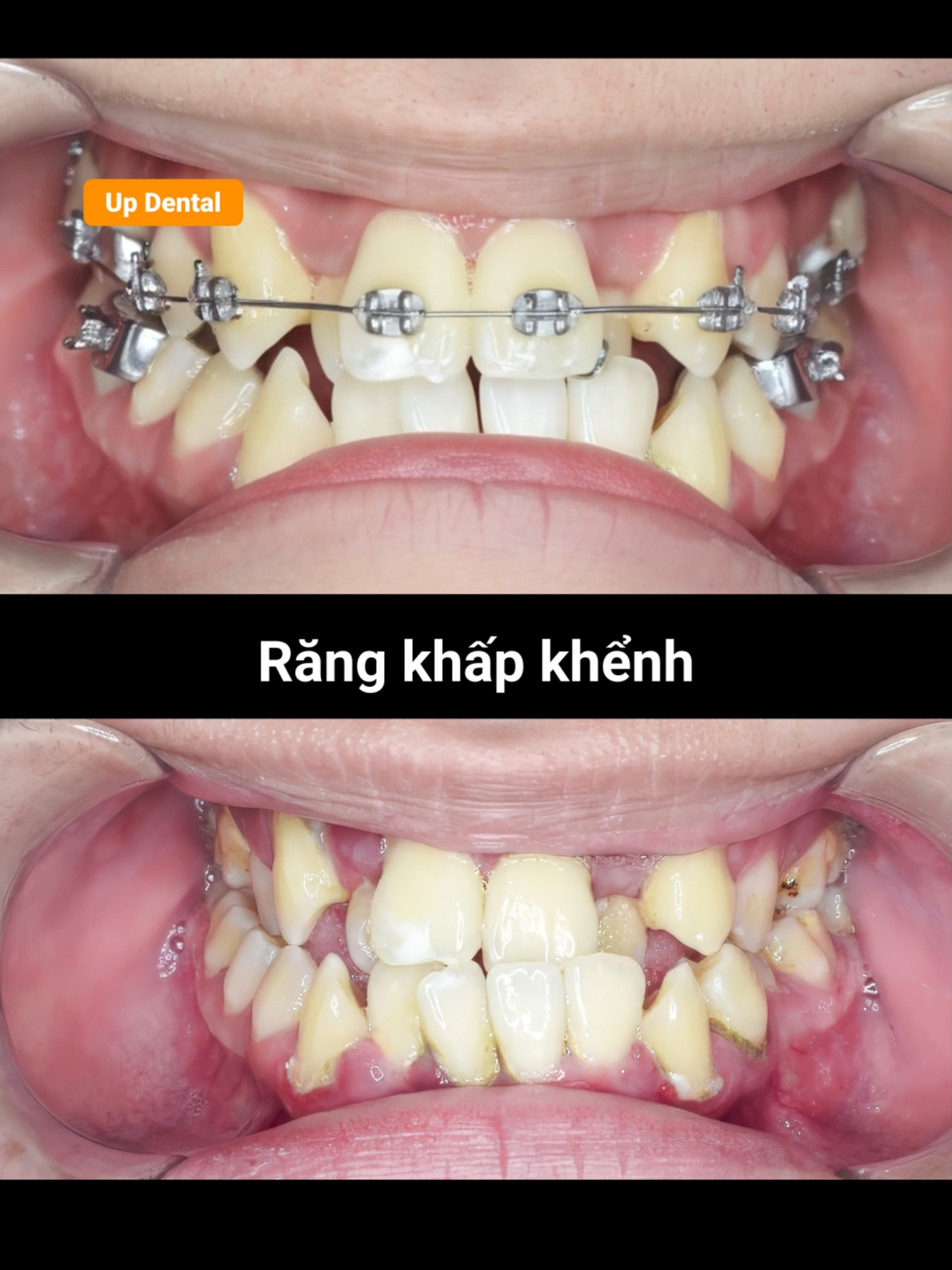 Cận cảnh niềng răng khấp khểnh bằng mắc cài kim loại #updental #nhakhoauytin #dental #braces #beforeafter #viral #trend #niengrang #maccaikimloai