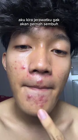 Aku juga dulu mikirnya gitu😣 #drleo #drleoid #acnebuster #acneessence #acnetreatment 