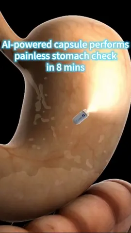 A tiny AI-powered capsule is changing stomach exams in China -- swallow it, wait 8 minutes, and you're done. No tubes, no anesthesia, no discomfort. Now priced under 280 U.S. dollars, the check is becoming more accessible and is expected to benefit even more patients in the future. #AICapsule #HealthTech #PainlessCheckup