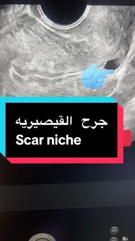 الدكتوره نعمات موسي اخصائيه النسا والتوليد والنسا التجميلي وتأخر الانجاب.                          Scar niches  اوجرح القيصيريه الغير ملتئم  #الدمام_الخبر_الشرقيه #افضل_دكتوره_الدمام #متابعه_ولايك #ترند #اكسبلور 