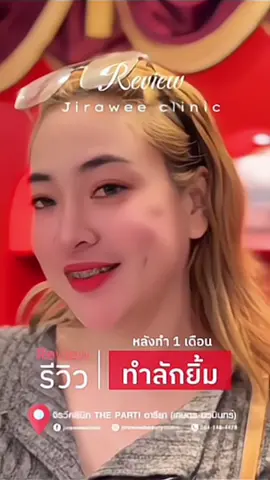 แค่ยิ้มก็ชนะแล้วค่ะ! ลักยิ้มสวยๆ ทำให้หน้าเฟรนด์ลี่ขึ้นทันที 😍 ราคาเบามาก 2,929.- แถม Stem Cell 2 cc. ฟรีแบบไม่ต้องคิดนานเลยค่ะ #JiraweeClinic #จิรวีคลินิก #ลูกสาวจิรวี #ลักยิ้ม #ศัลยกรรม 