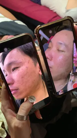 Cập nhật da mụn thâm #chamsocdamun#chamsocdaseo#chamsocdanam#tanbinh#Lqspa&academy