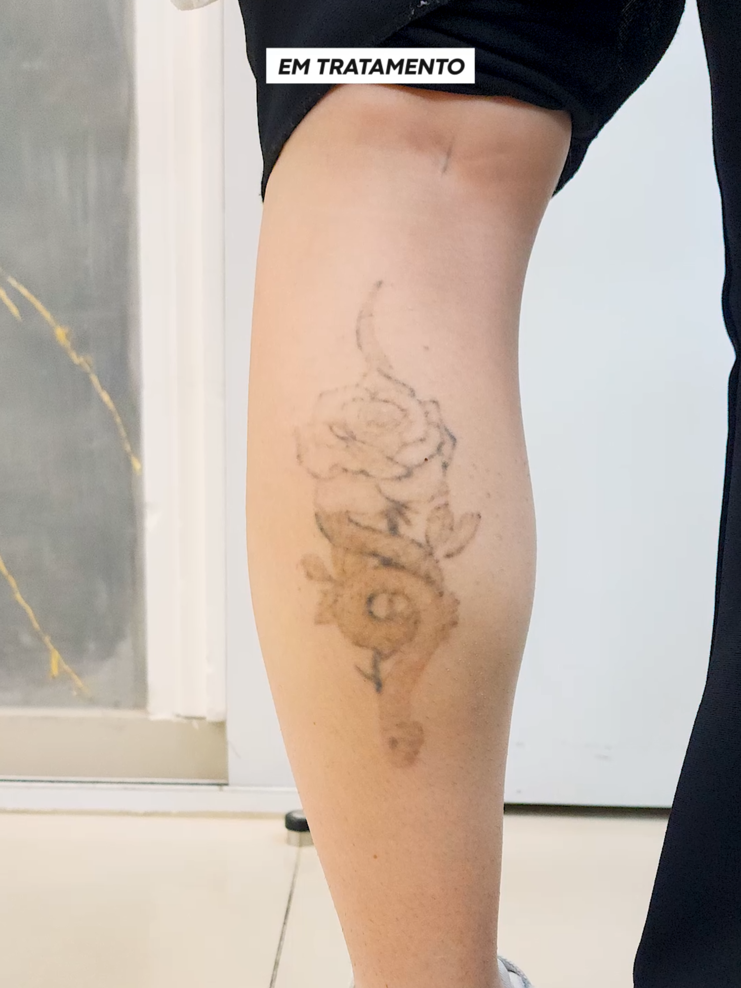 Remoção a laser da tatuagem de serpente com rosa na panturrilha: processo real de clareamento seguro.