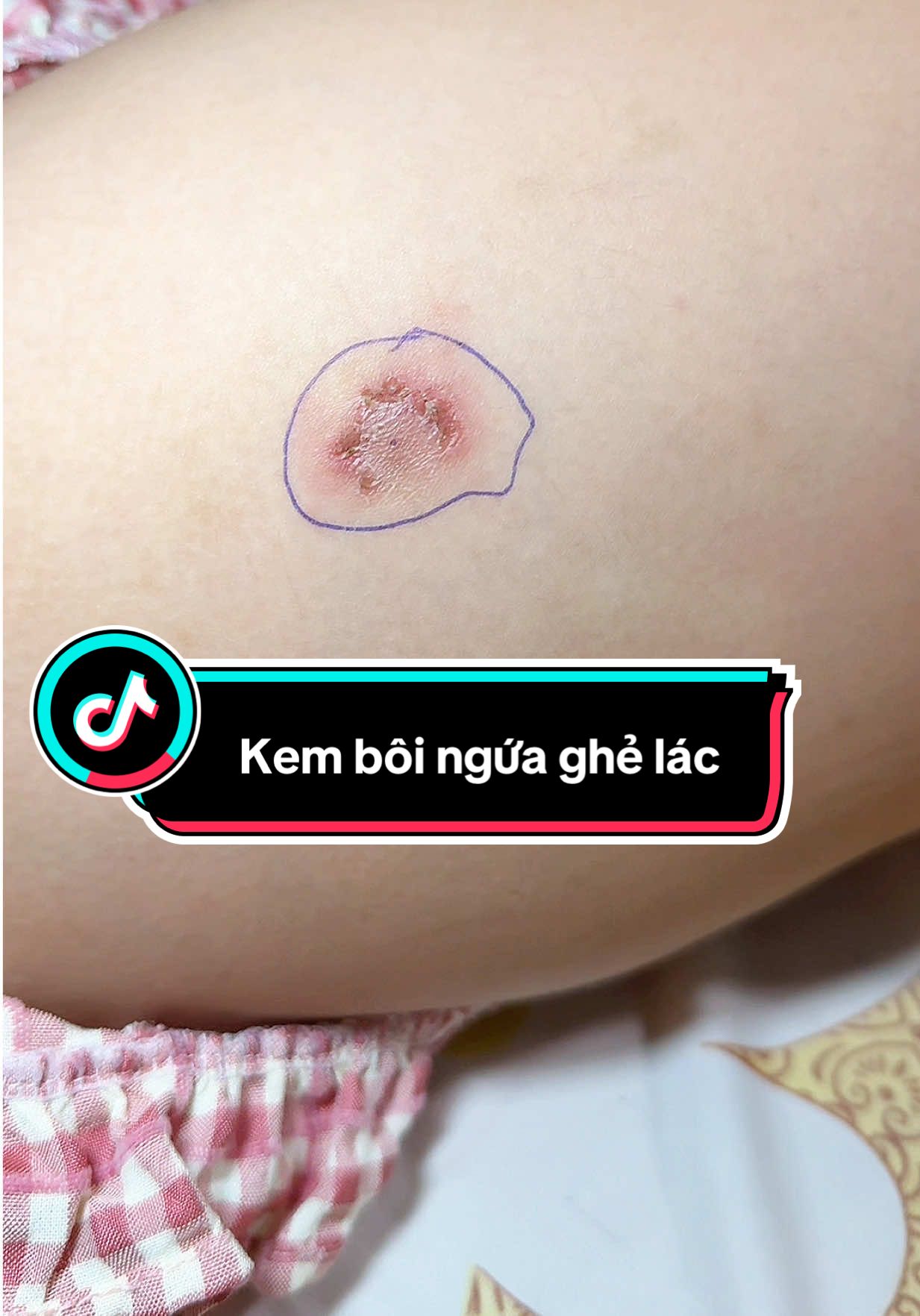 Kem bôi ngứa ghẻ lác dị ứng da , nấm móng nước ăn tay chân hay lắm luôn #huynhphiyen #kemboinamngua #kemboilangben #viraltiktok #xuhuong  @Huỳnh Phi Yến  @Huỳnh Phi Yến  @Huỳnh Phi Yến 