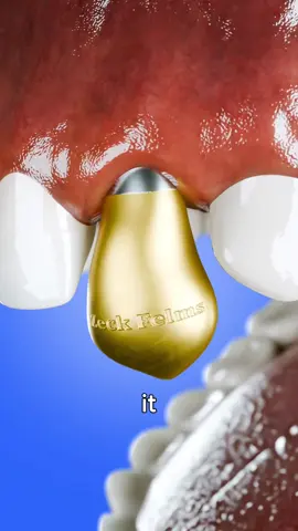 Having Gold Teeth Can Be Painful 😱 #zeckfelms