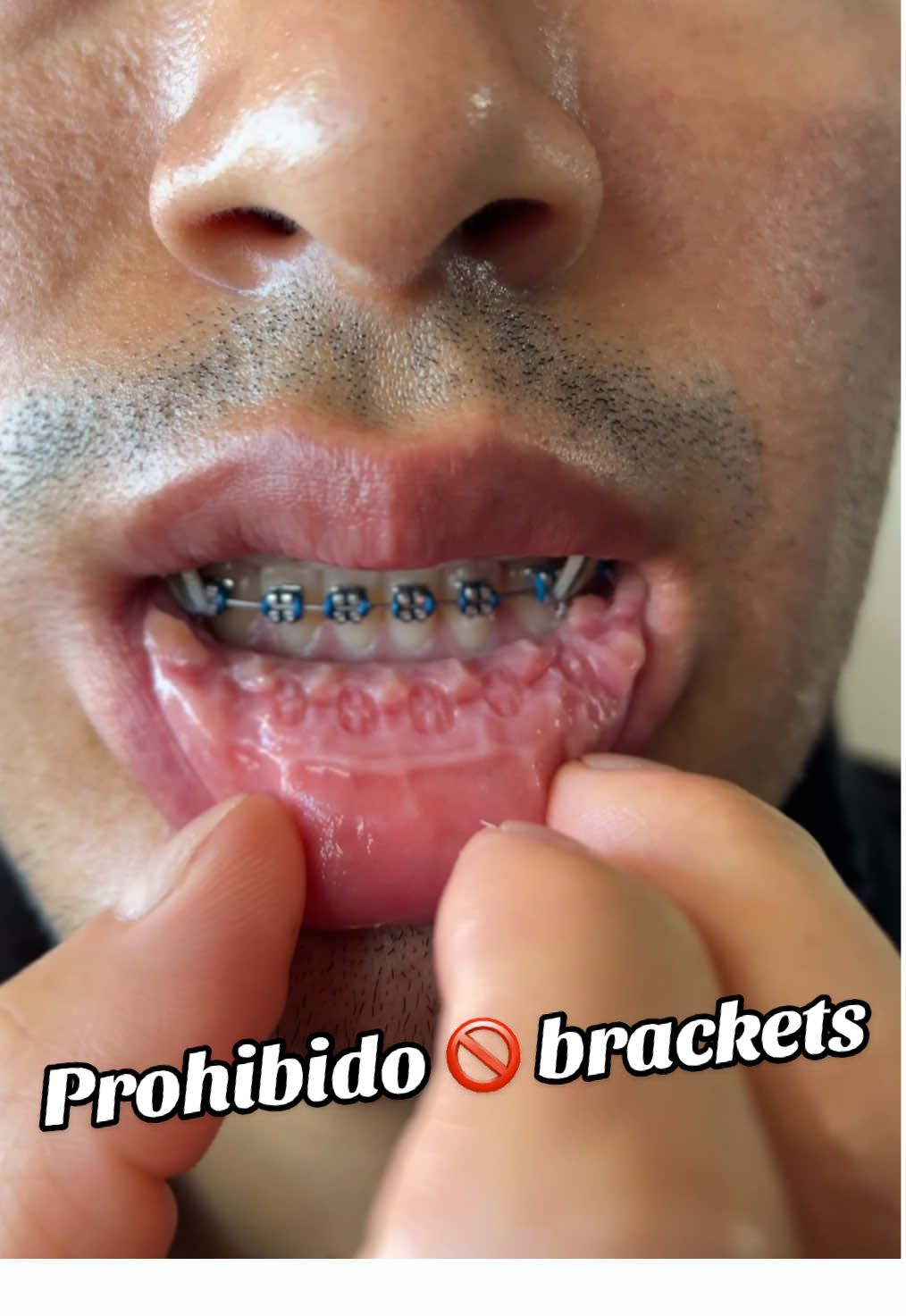 Que maldito dolor 😭 #miedo #brackets #brace 