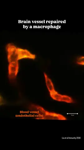 Did you know a single immune cell can repair a brain vessel? 🧠🩸 We’ve looked at immune cells fighting cancer and chasing pathogens in my previous reels… but their abilities go far beyond that. Here’s one of their most unexpected jobs: repairing a broken blood vessel in the brain. In this real-time zebrafish video, a single macrophage (in green!) rushes to a ruptured brain blood vessel - the kind of break that can cause hemorrhagic stroke or microbleeds - and literally grabs both loose ends and pulls them back together. Using high-resolution live imaging and a laser-induced rupture model, researchers discovered that macrophages don’t just clean up damage.  They physically fix it! They extend filopodia and lamellipodia, adhere to each broken end, and generate traction forces that help the vessel reseal. This reveals a completely new role for macrophages in maintaining brain vascular integrity and can open doors to new stroke therapies. Credits: Liu et al Immunity 2016 #scientist #Science #medicine #immunology #biology 