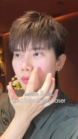 ลองทำ Red Touch Pro Laser มาครบ 3 เดือนแล้ว ทำเดือนละ 1 ครั้ง เอาผลลัพท์มาให้ดู ข้อดีมากๆเลยคือ เหมาะกับคนใช้หน้าทำวัน ไม่ต้องพักฟื้นไปทำวานต่อได้เลย  พิกัด @dskclinic  #DskClinic #redtouchprodskclinic 