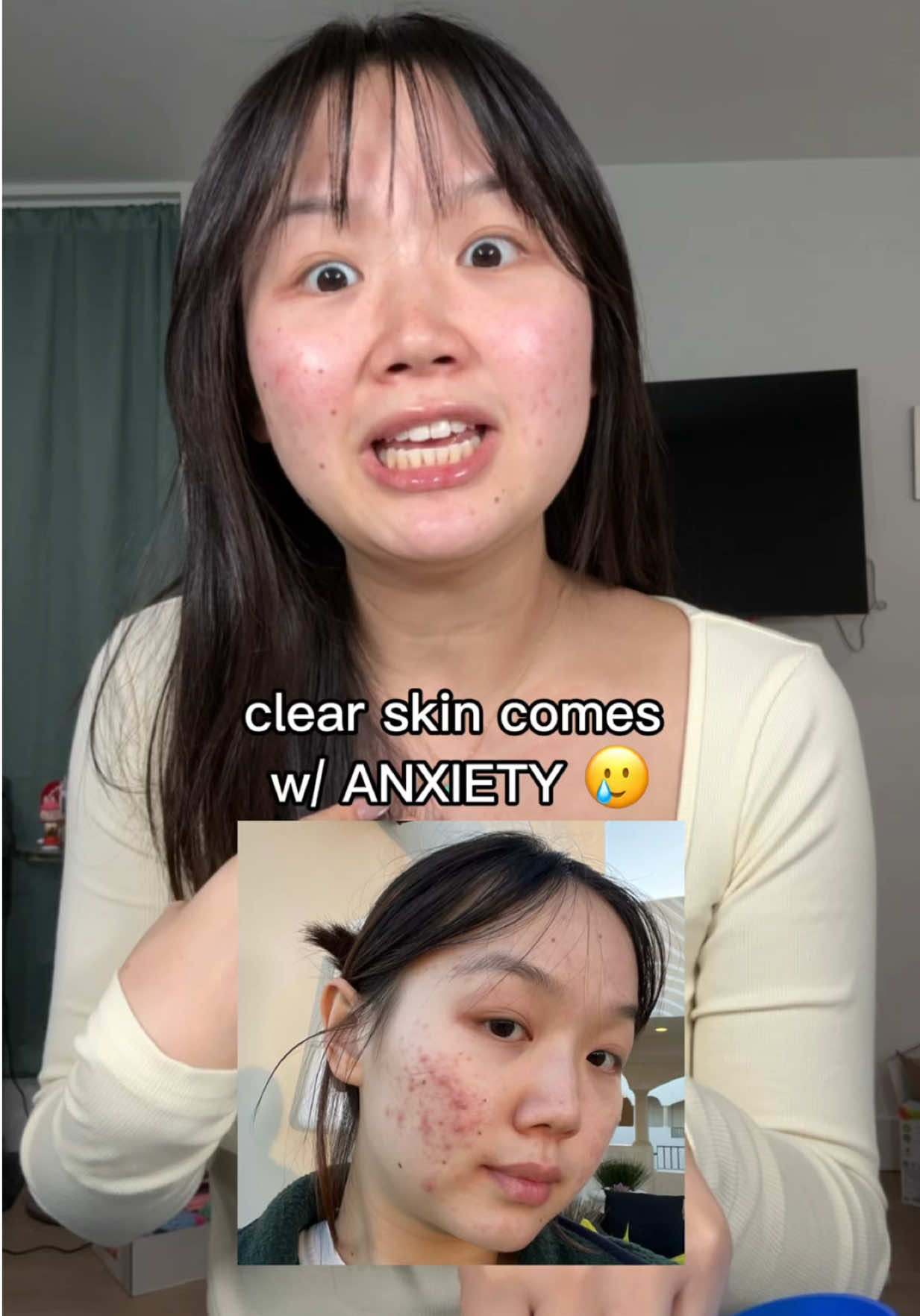 Pls tell me I’m not the only one who feels this way 😀🥲 #acne #clearskin #skincare 