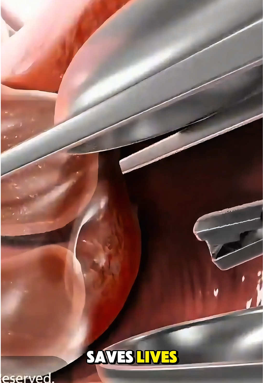 Part 35 | Ever wondered how cervical cancer can be detected through Pap smear? Disclaimer: This video is for educational purposes only and is intended to raise awareness about medical procedures. It does not violate  TikTok community guidelines and contains no graphic or harmful content. #PapSmear#CervicalCancerAwaeness#WomenHealth#EarlyDetection#CancerPrevention 