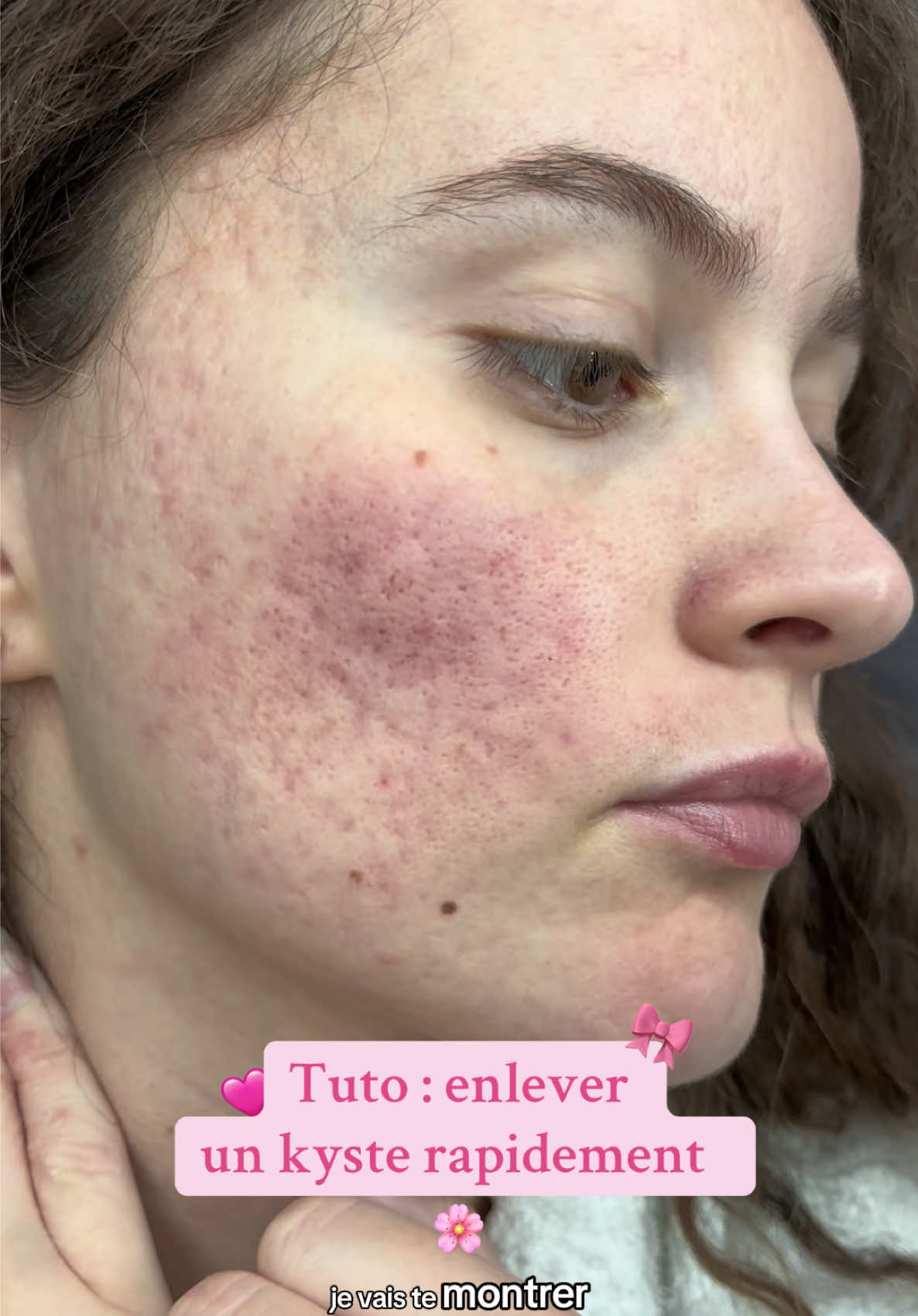 15% skin and out : MOCEANE15 Tu as de l’acné et tu souffres avec tes kystes, je te montre ma plus belle découverte : les patch micro aiguilles de chez @Skin & Out si tu veux faire des économies utilises le code promo MOCEANE15 tu me remercieras plus tard 🩷 #acné #acnefighter #kyste #acneproneskin #acnehormonal 