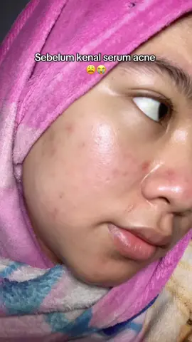Penyelamat wajah smua jenis smua jenis jerawat🔥🥰@Owner Shesile beauty @shesile beauty glow #skincaretips #BeautyTok #fyp #pejuangacne 
