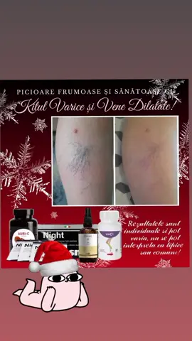 #varice #venedilatate #kitpentruvarice #picioareumflate 