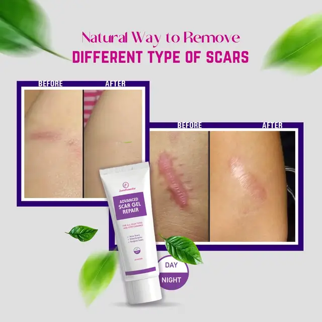 Advanced ScarGel Repair helps fade old and new scars, smooth skin texture, and promote faster, healthier skin recovery. #zuwacosmetics #tiktoknepal ##zuwacosmeticsproducts #scargel #scarsremover 