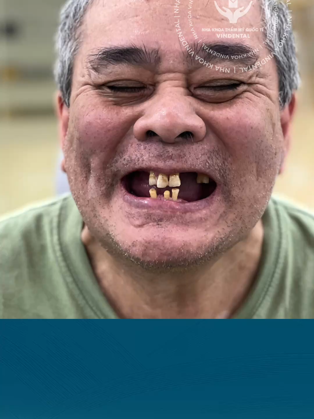 LẠ ĐỜI! Chú Việt kiều Đức nhất quyết trở về Việt Nam để làm răng! #VindentalLuxury #nhakhoauytin #cayghepimplant #trongrangtoanham #implant