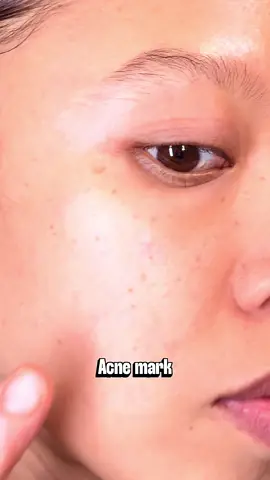 Struggling with those annoying post-acne marks? 😫 I'm joining the #NoMoreMarksChallenge with the @PURITO SEOUL Mighty Bamboo Panthenol Cream and the results are looking promising! ✨ Ready to try the Real Post-Acne Cream yourself? 👇 🛒 Get yours now on YesStyle and use my code SIMPLYJULZ5 at checkout to save some money! #Purito #PanthenolCream #RealPostAcneCream #Koreanskincare