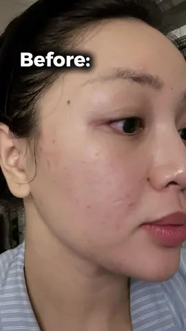 Càng ngày test càng nhiều loại thì tui đã hiểu vì sao mọi người rất khen Retinol. Mọi người cố gắng duy trì để có kết quả tốt nhất nhen 🫶🏻 #viral #fyp #fusionretinol #retinolfusion 