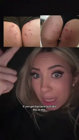 this helped soooo much with my butt acne and hyperpigmentation #hyperpigmentation #drmelaxinpeelshot #buttacne 