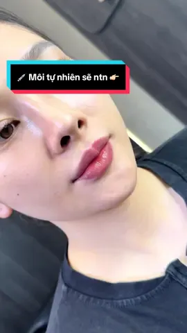 Tiêm môi tự nhiên sẽ ntn 👉🏻💉 #xhtiktok 