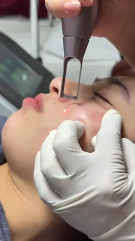 💁‍♀️Ca laser nám tàn nhang tại Ro chỉ vậy thui hẹ hẹ☺️ #lasernam  #lasertannhang  #nam #nammang  #munnamtannhang 