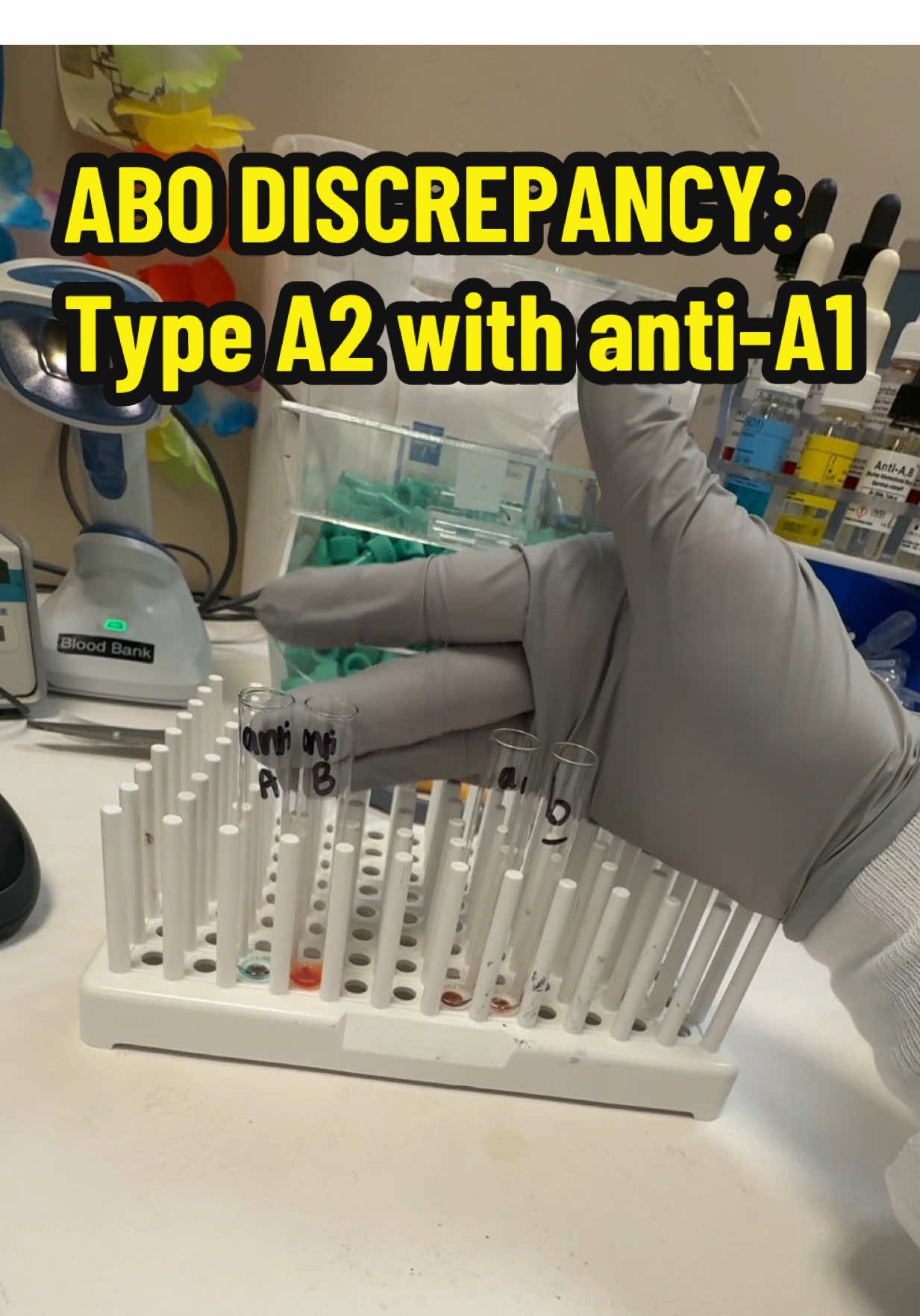 ABO discrepancy: Type A on forward and type O as reverse? 🤔 you can see this on a patient with type A2 who developed an anti-A1 antibody! They should only receive O blood. 