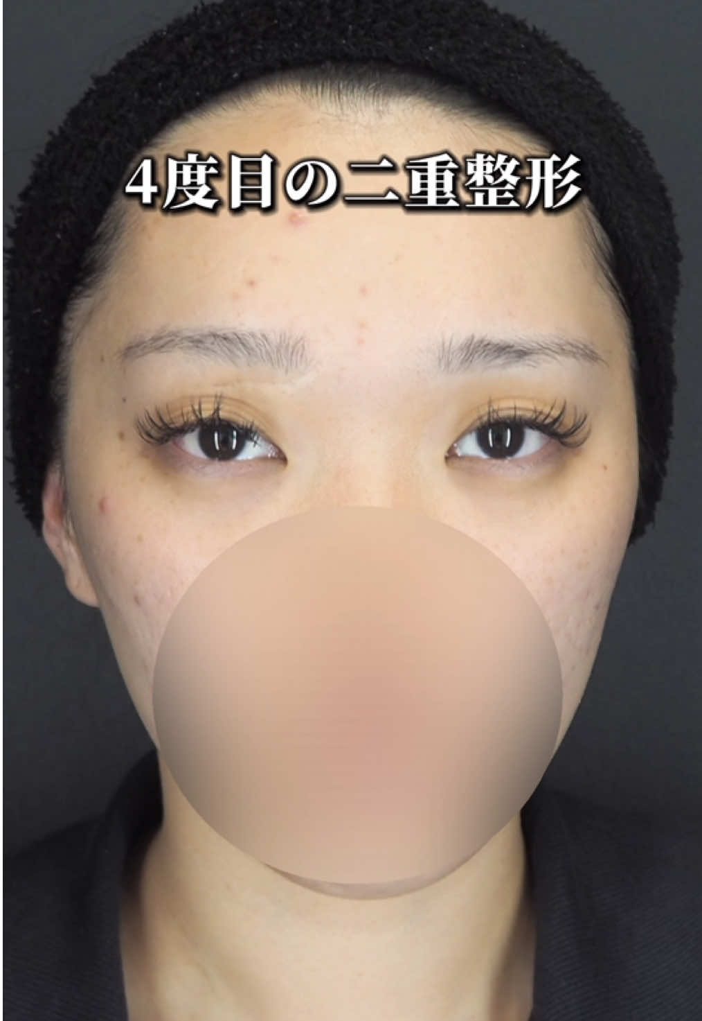 4度目の二重整形 #二重整形 #二重埋没 #ルシアクリニック #ドクター小原 #二重になりたい 