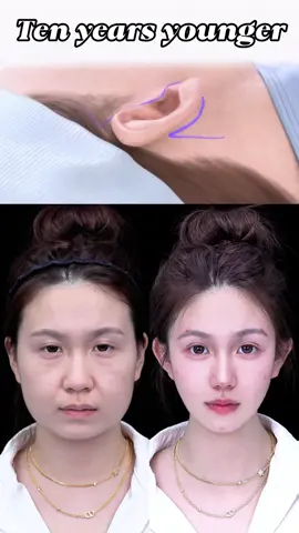 #微調 #整形 #抗衰逆龄 #面部提升 #變美 #面部提升 #面部提升 