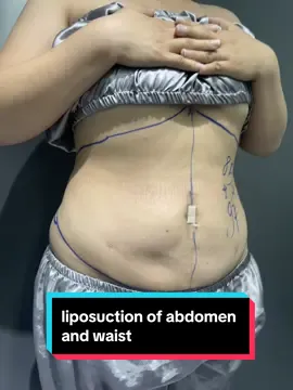 #Dr_Lee #liposuction #manila #philippines 