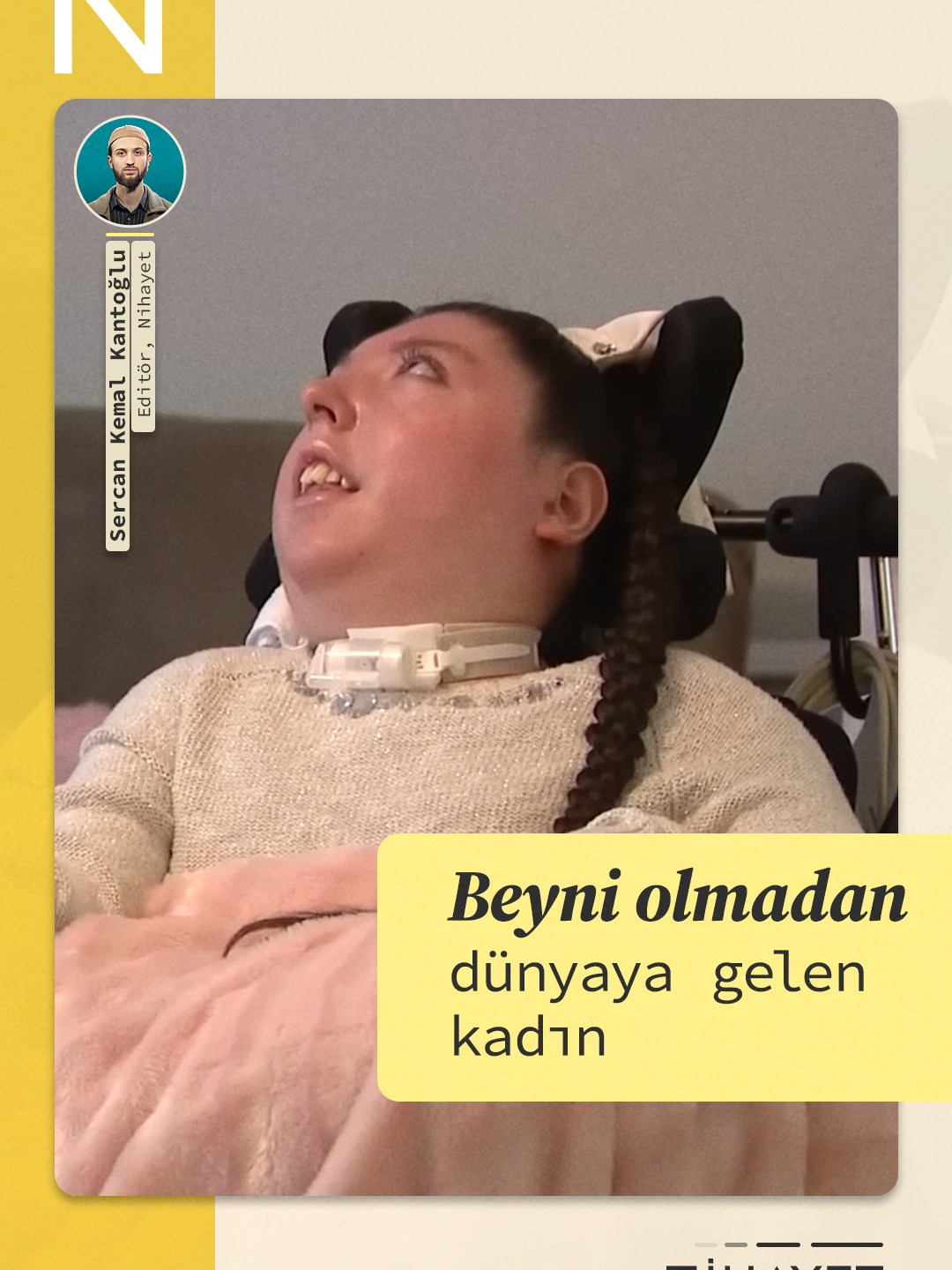 Beyni olmadan dünyaya gelen kadın 🧠 👀 Babasının tarifiyle kafatasının içinde sadece 