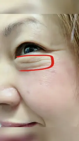 On stop solution for Dark circles , puffy eye and wrinkles is Zuwacosmetics rerinol combo set #zuwacosmetics #zuwacosmeticsproducts 