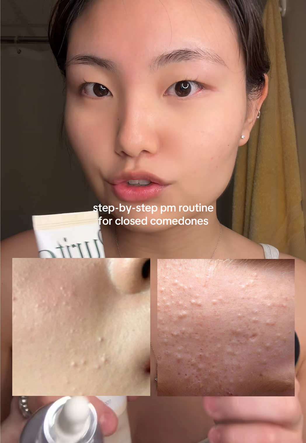 products: @Sofie Pavitt Face mandelic acid serum, @IUNIK US beta glucan serum, @PURITO SEOUL oat-in calming gel cream #skincareroutine #closedcomedones #iunik #iunikbetaglucan #iunikhydrationserum