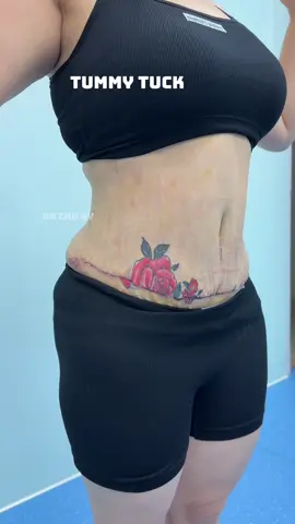 Tummmytuckk#beauty #drcaoky #Change 