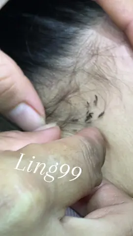 Remove lice #omg😘😘😘😍😍😻😻😽😽🥳🥳😂😂😂 #liceremoval #lice 