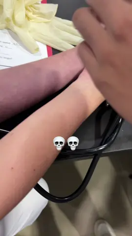 🤣🤣🤣 In our Lab for todayy we did the Capilliary fragility testing . one of the groups showed this discoloration at 90mmHg, she turned into a zombie HAHAHAH The explaination was that discoloration is more prominent on pale skin
