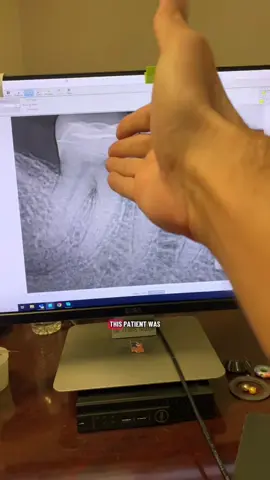 #dentists #dentalstudent #rootcanal #dentalhygienist #dentalofficelife 