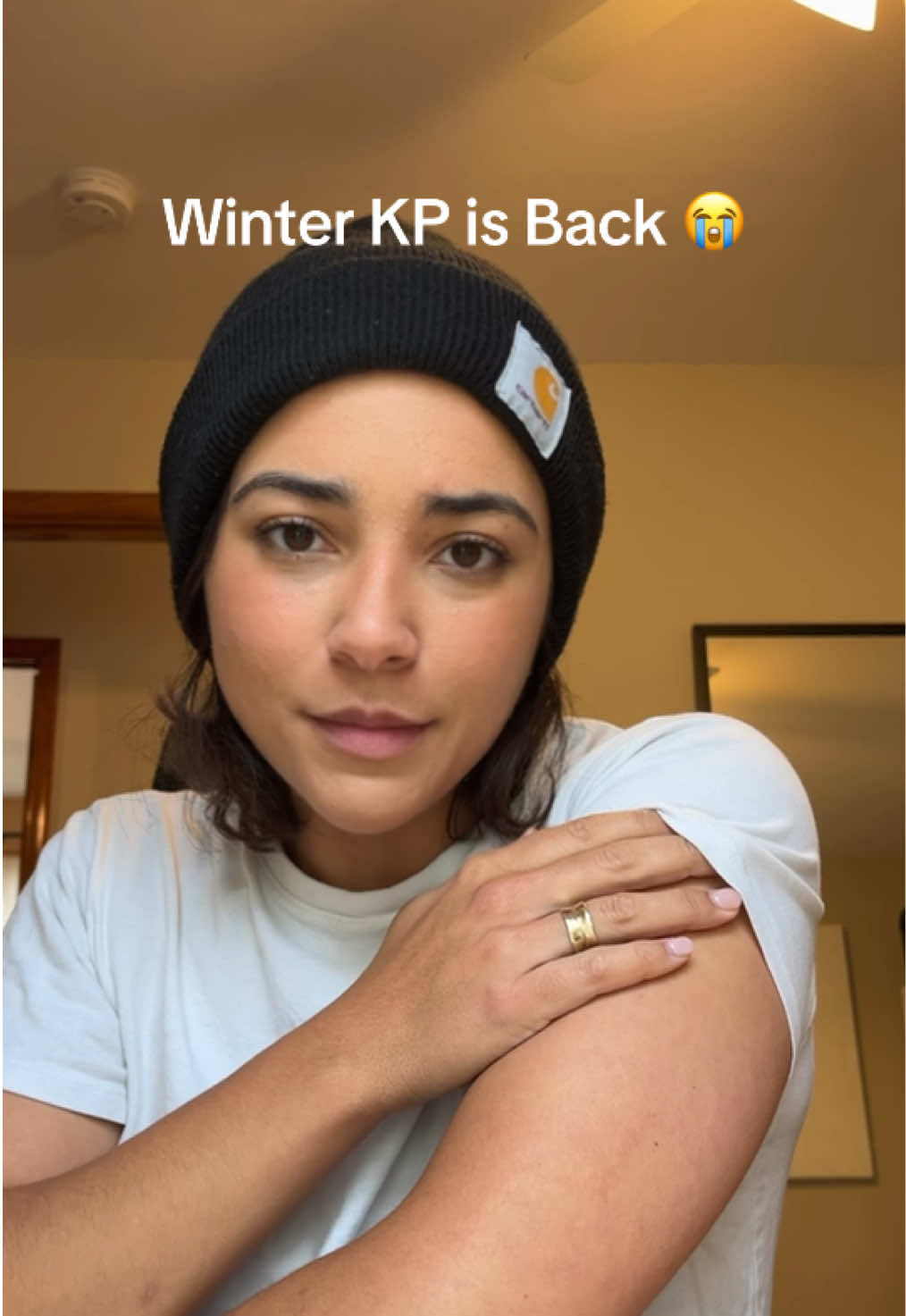 If your kp gets worse in the winter, this body oil is the only thing that has ever smoothed mine. I’ve tried everything- nothing worked until this. Winter skin doesn’t stand a chance!!!!!! #kpbumps #skincareroutine #bodycaretips #dryskintips #momhacks 