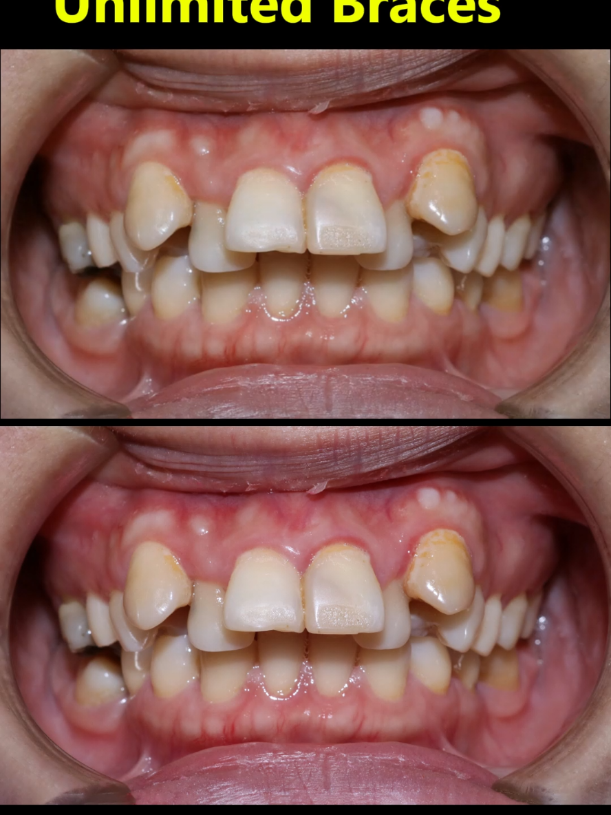 Unimited braces. Fix super crooked teeth #braces #orthodontist #niengrang 